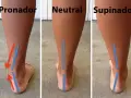 Comparación de pisadas: pronador, neutral y supinador. El desgaste de zapatillas varía según el tipo de pisada.