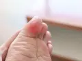 Pie de niño con ampolla roja en el dedo gordo, resultado de largas caminatas o juegos.