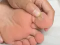 Una ampolla en la planta del pie, cerca del dedo gordo, se ve claramente.