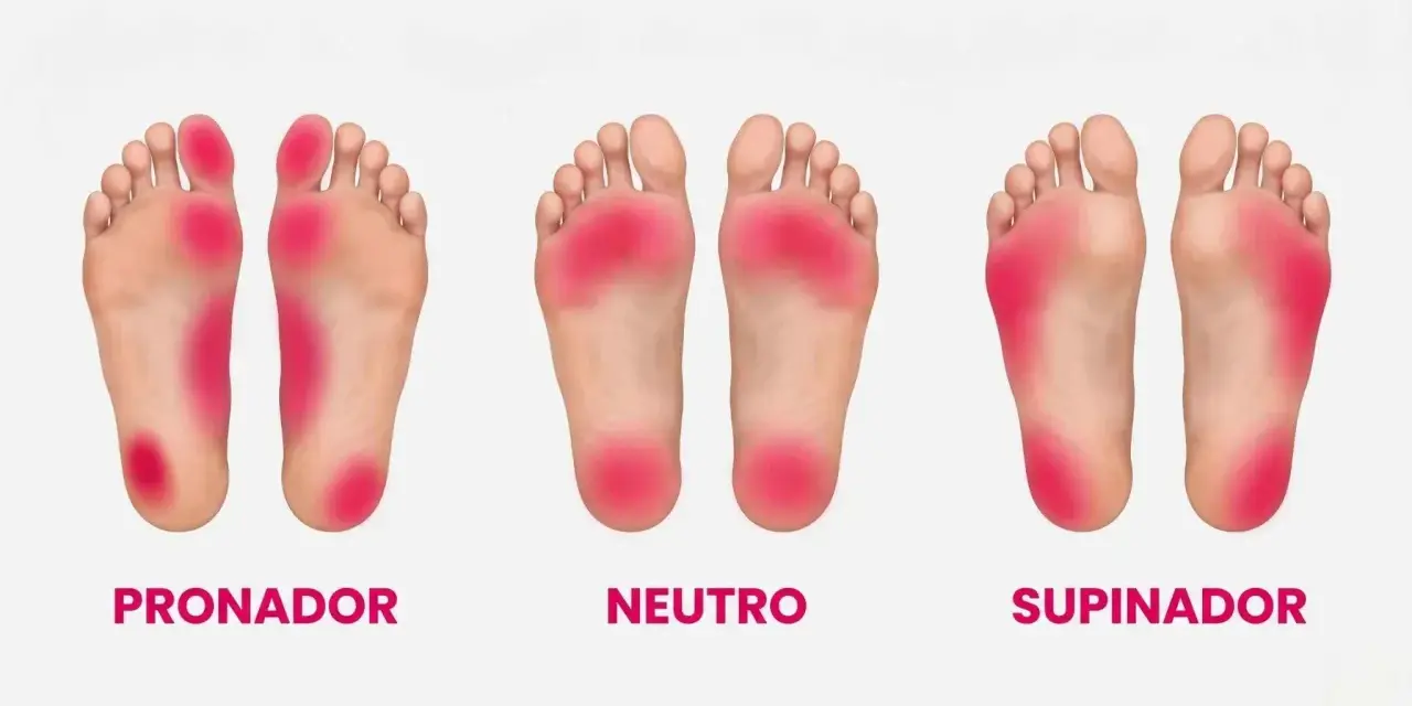 Plantillas de pies con zonas de presión marcadas en rojo. La primera muestra una pisada pronadora, con mayor carga en el talón interno y el dedo gordo.