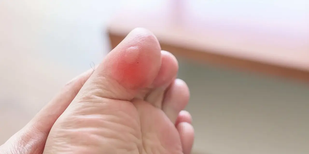 Pie de niño con ampolla roja en el dedo gordo, resultado de largas caminatas o juegos.