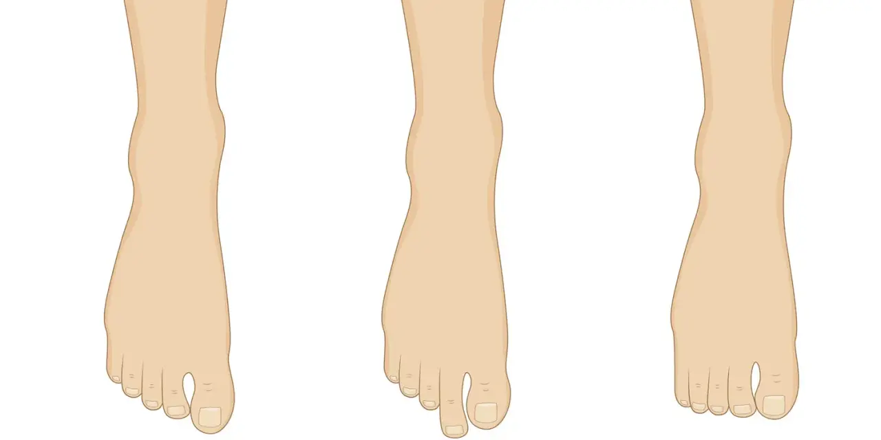 Tres tipos de pies: el pie egipcio con el dedo gordo prominente, el griego con el segundo dedo más largo, y el romano con dedos de longitud similar.