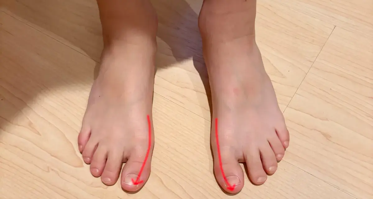 Pies con líneas rojas que indican la desviación del dedo gordo. La pregunta es a qué edad salen los juanetes.