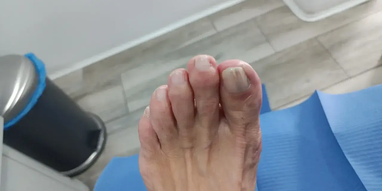 Pie con signos de artrosis en los dedos, mostrando deformidad y uñas afectadas.