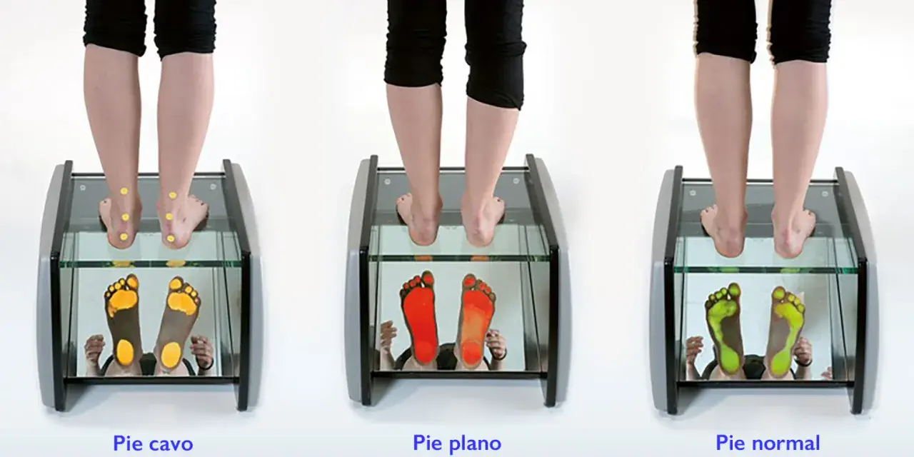 Análisis de pisada: pie cavo, pie plano y pie normal. Las huellas muestran la presión en cada tipo de pie.
