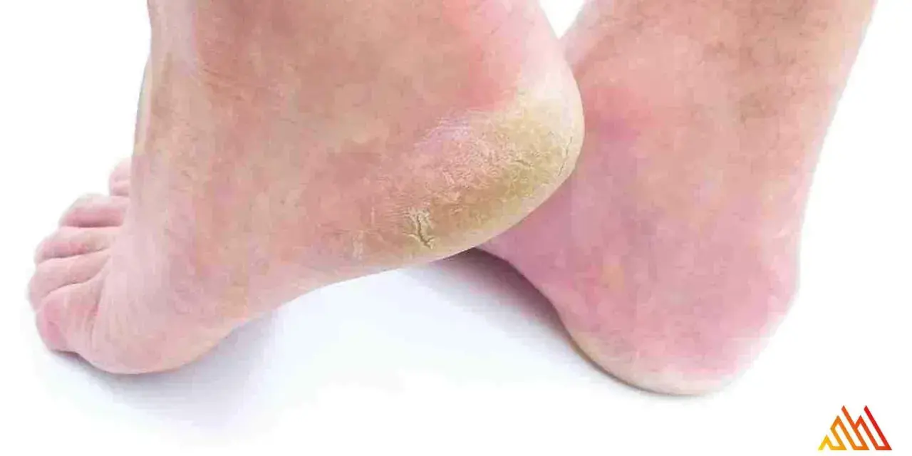 Pies con talones agrietados y secos. Aprende como curar rozaduras en los pies para tener una piel suave y sana.