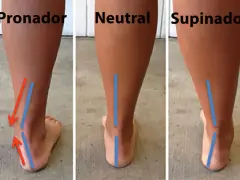 Comparación de pisadas: pronador, neutral y supinador. El desgaste de zapatillas varía según el tipo de pisada.