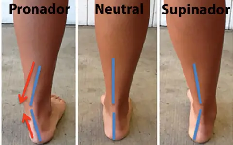 Comparación de pisadas: pronador, neutral y supinador. El desgaste de zapatillas varía según el tipo de pisada.