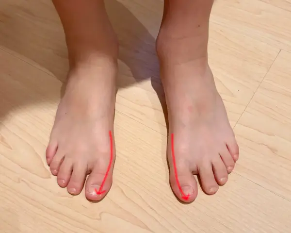 Pies con líneas rojas que indican la desviación del dedo gordo. La pregunta es a qué edad salen los juanetes.