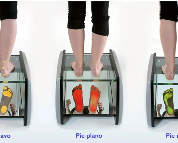 Análisis de pisada: pie cavo, pie plano y pie normal. Las huellas muestran la presión en cada tipo de pie.