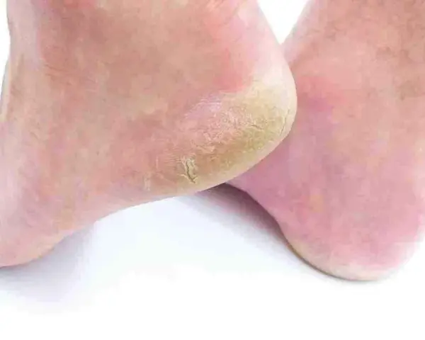 Pies con talones agrietados y secos. Aprende como curar rozaduras en los pies para tener una piel suave y sana.