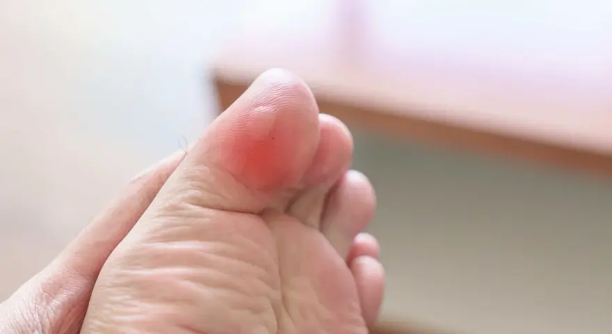 Pie de niño con ampolla roja en el dedo gordo, resultado de largas caminatas o juegos.