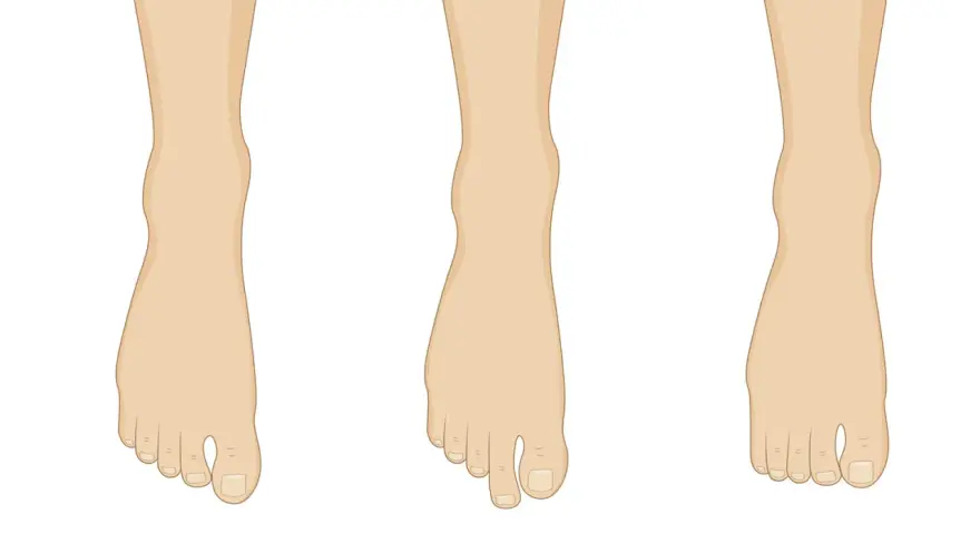 Tres tipos de pies: el pie egipcio con el dedo gordo prominente, el griego con el segundo dedo más largo, y el romano con dedos de longitud similar.