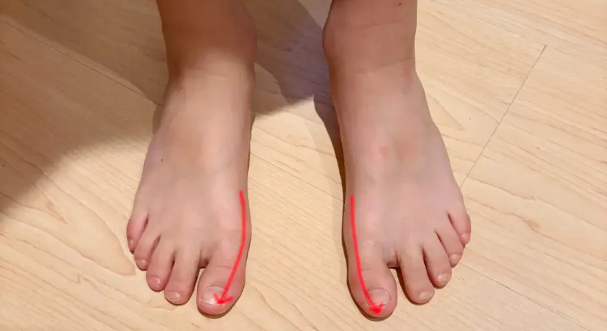 Pies con líneas rojas que indican la desviación del dedo gordo. La pregunta es a qué edad salen los juanetes.