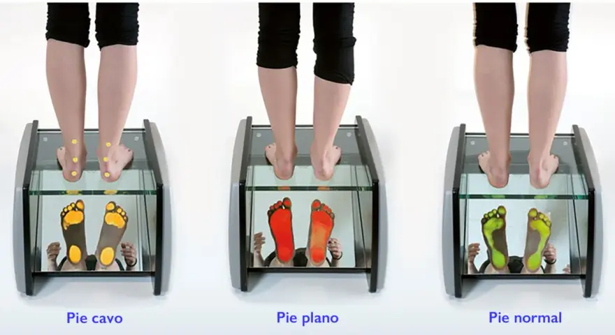 Análisis de pisada: pie cavo, pie plano y pie normal. Las huellas muestran la presión en cada tipo de pie.