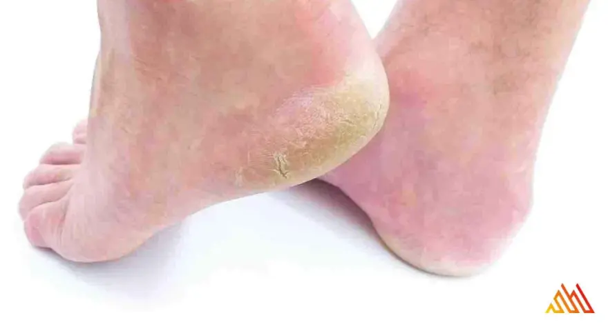 Pies con talones agrietados y secos. Aprende como curar rozaduras en los pies para tener una piel suave y sana.