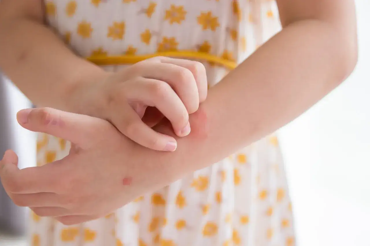 Ni&ntilde;a se rasca el brazo con erupciones rojas, posiblemente por una alergia al detergente de ropa.