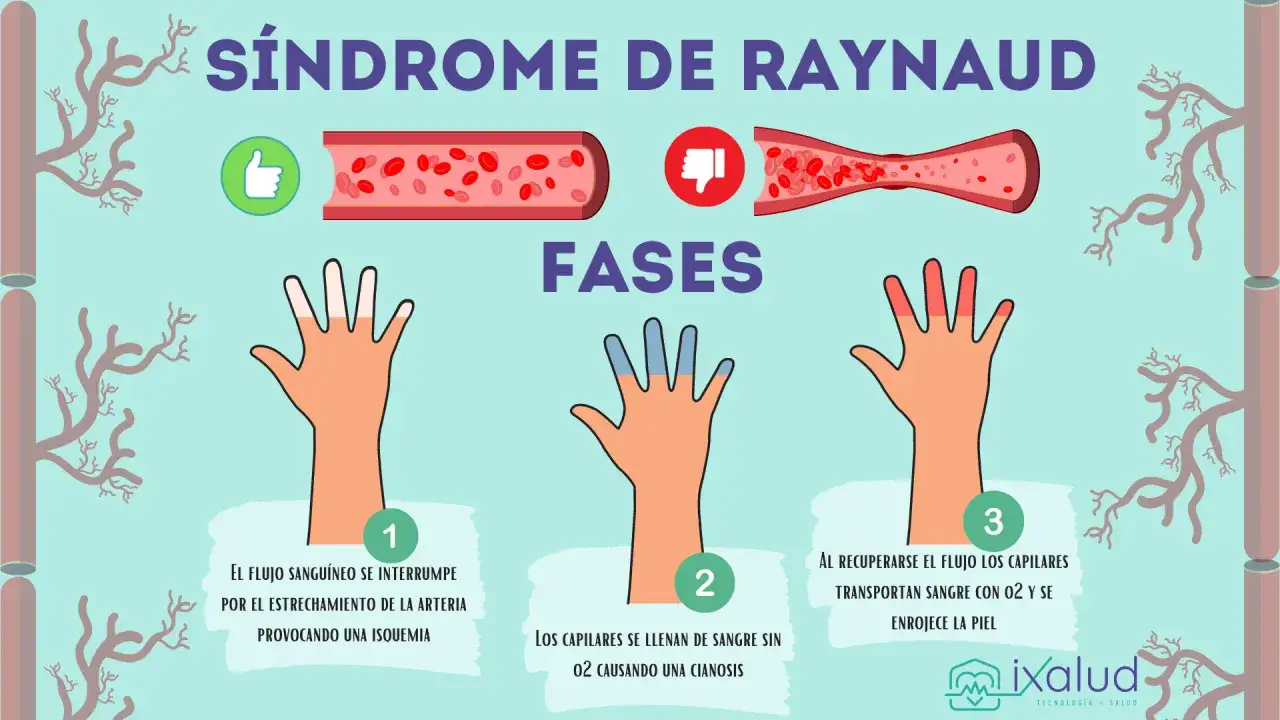 Ilustración del síndrome de Raynaud: manos con dedos fríos y pálidos, luego azulados y finalmente enrojecidos, mostrando las fases de la enfermedad.
