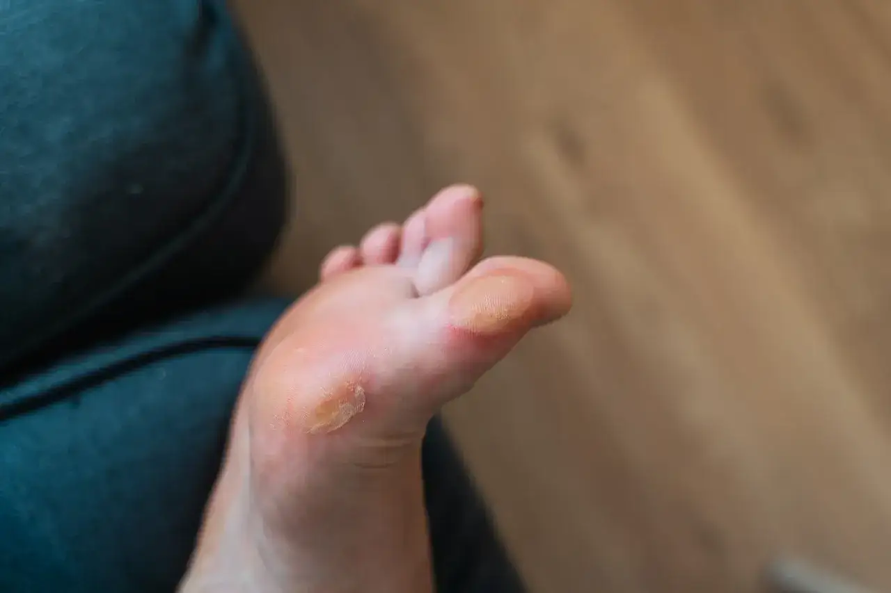 Pie infantil con ampollas en los dedos y planta, resultado de largas caminatas o zapatos inadecuados.