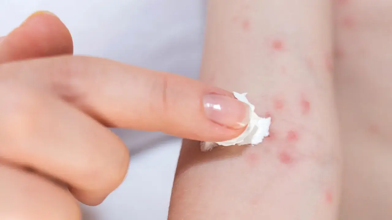 Dedo aplicando crema sobre piel con sarpullido rojo, posible alergia al jabón.