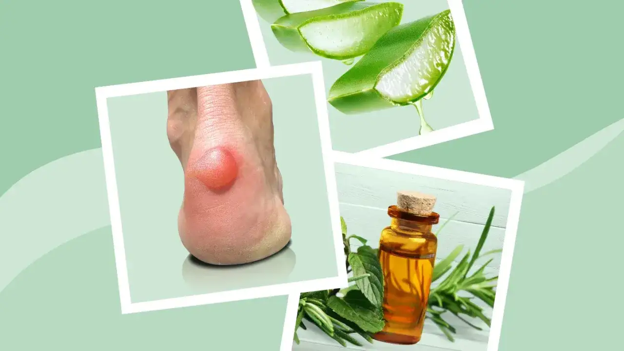 Alivio para la rozadura planta pie: aloe vera y aceite esencial para calmar la ampolla.