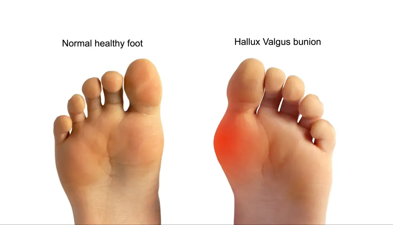 Comparaci&oacute;n de un pie sano con uno con juanete (hallux valgus). Los juanetes pueden aparecer a cualquier edad.