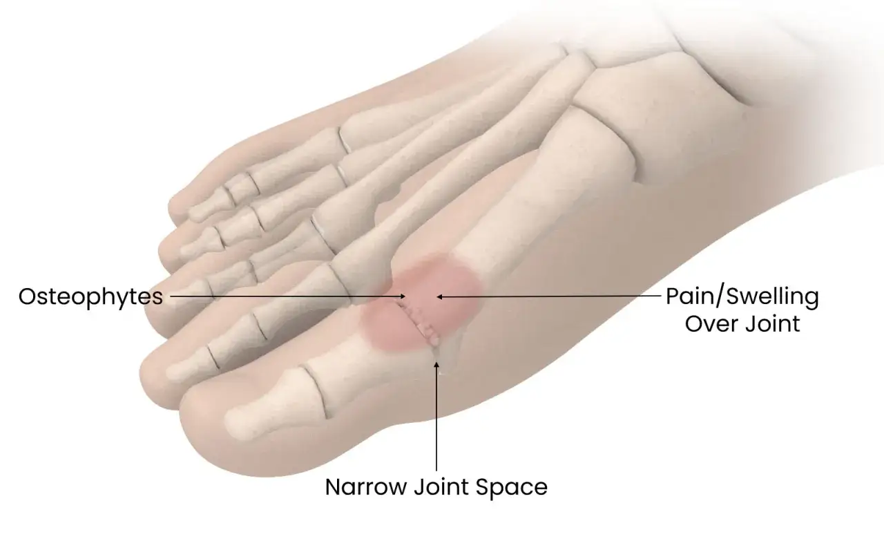 Ilustración de un pie que muestra osteofitos y espacio articular reducido, indicando dolor lateral dedo gordo pie.
